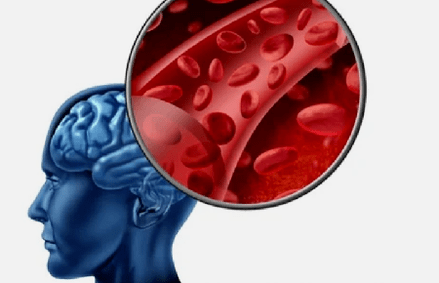 symptomen van osteochondrose van de cervicale wervelkolom