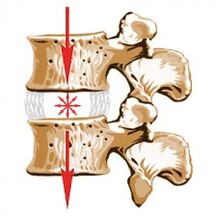 Het apparaat van de wervelkolom en de oorzaken van osteochondrose