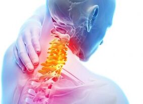 Pijn en schieten in het cervicale gebied met osteochondrose van de derde graad